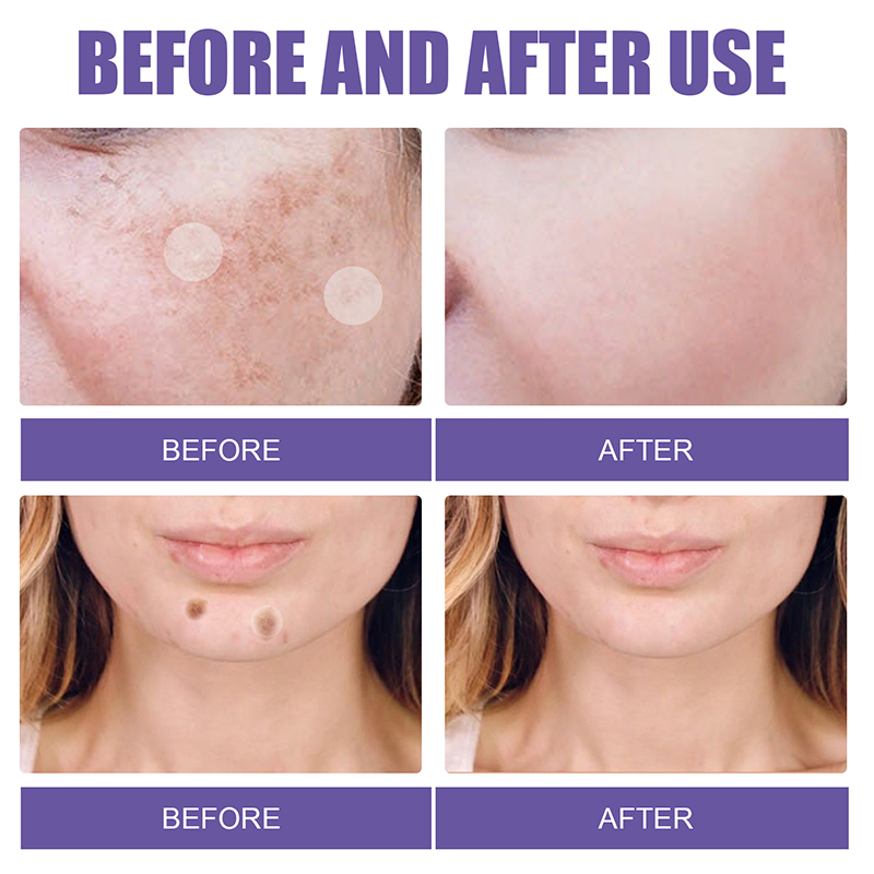 Dark Spot Removal Patch Gentle Facial Skin Care Spots Cleansing Skin Treatment Stickers - Image 5